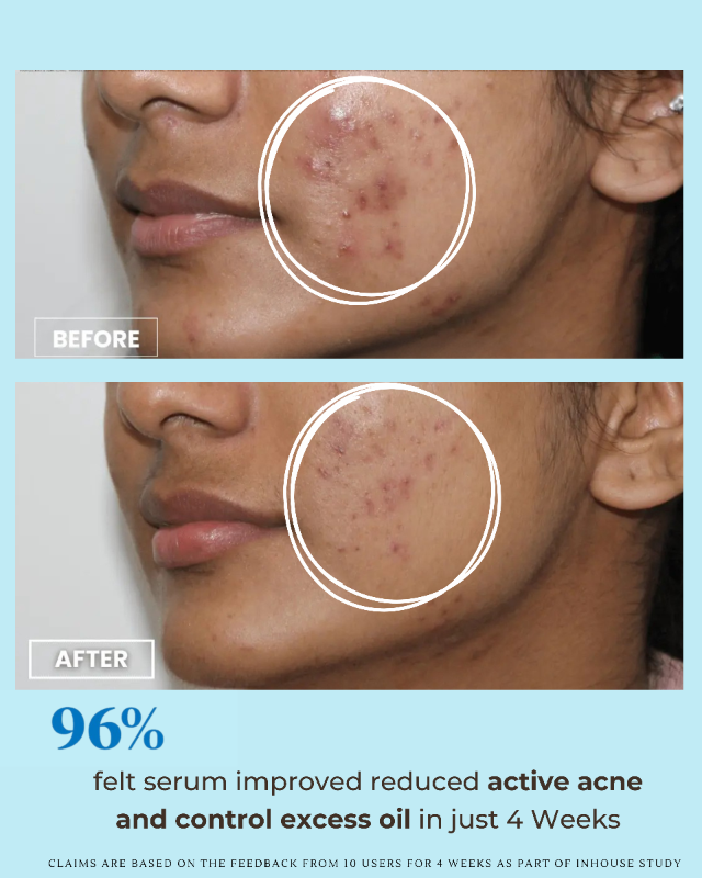 Pore Purify Oil Control Serum | 5% Niacinamide and 1% Zinc PCA