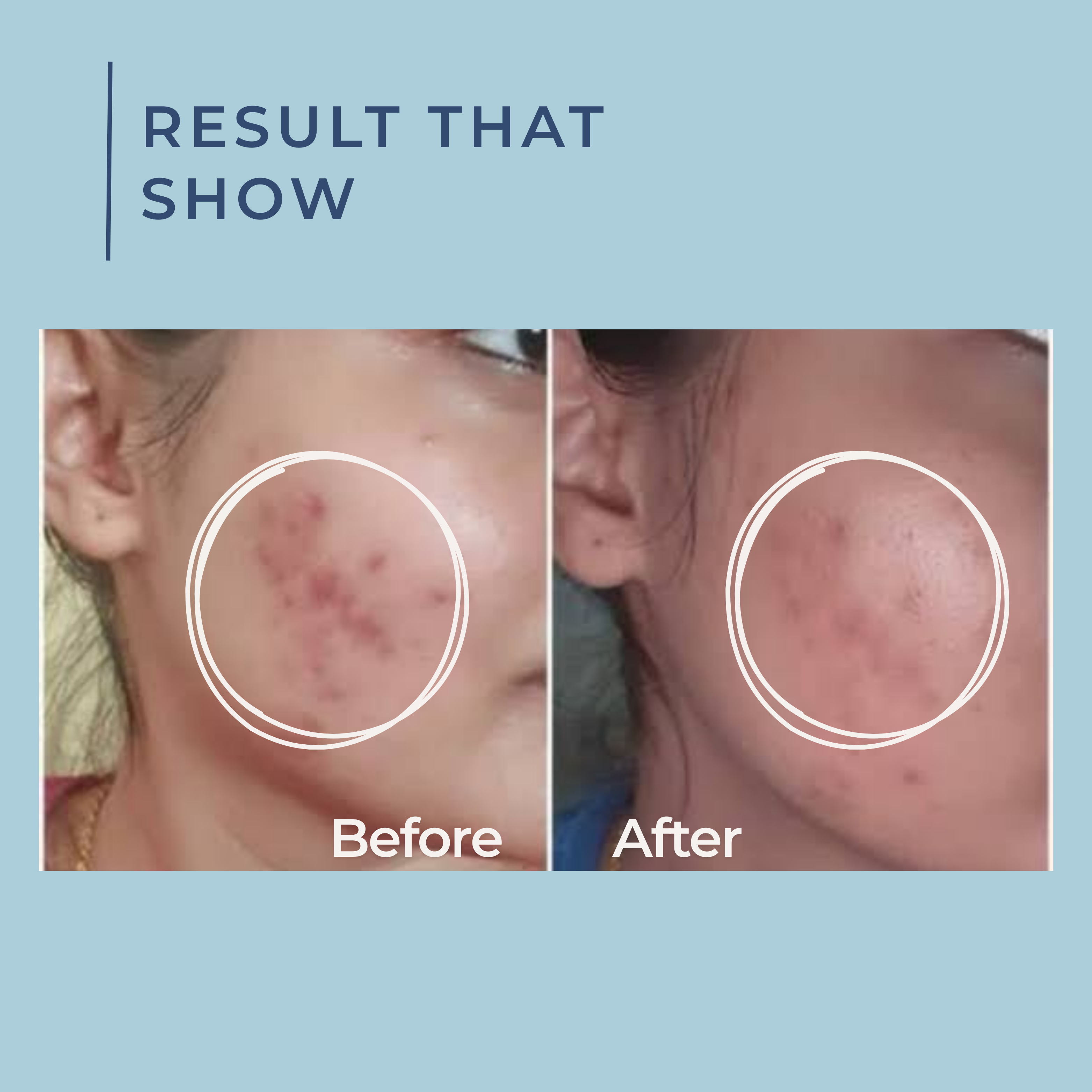 Cica Calming Oil Control Foaming Facewash | 2% Salicylic Acid and 1% Zinc PCA