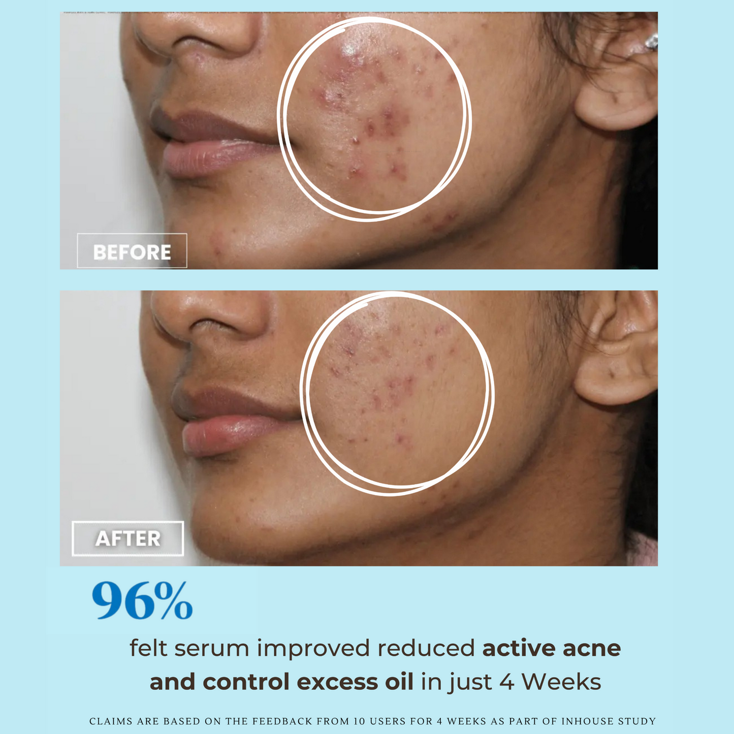 Pore Purify Oil Control Serum | 5% Niacinamide and 1% Zinc PCA